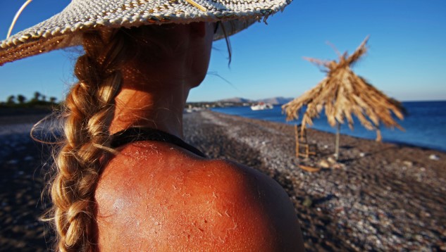 Study Suggests Alcohol Causes Skin to Sunburn Faster