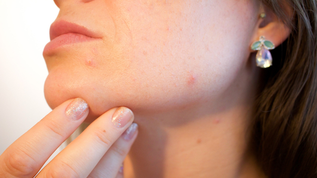 What Your Adult Acne is Telling You About Your Health