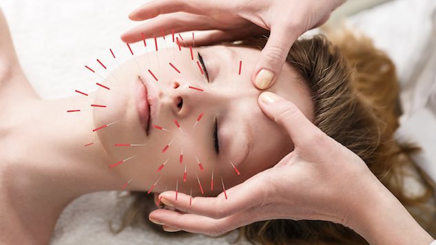 Image result for acupuncture